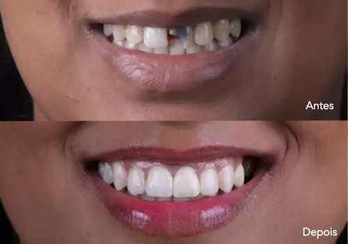Imagem ilustrando a diferença entre o antes e depois do implante dentario