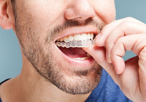 Imagem ilustrando um homem removendo seu aparelho removivel Invisalign