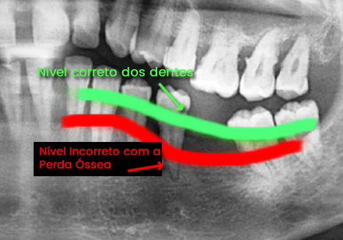 Imagem mostrando os niveis de diferença entre o nivelamento correto dos dentes sem perda óssea, comparado ao nivelamento da perda óssea