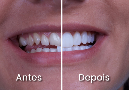 Imagem ilustrando o antes e depois que foi feito o tratamento com facetas dentárias para correção de imperfeições