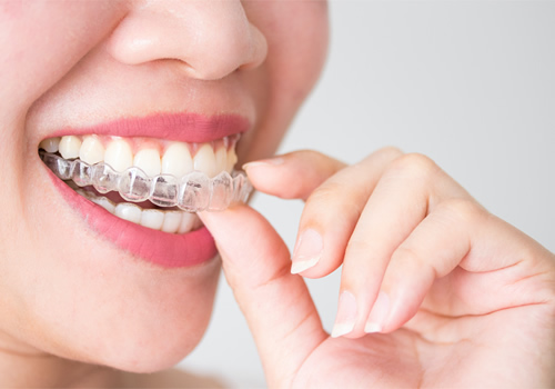 Imagem ilustrando uma mulher sorrindo com os dentes alinhados, encaixando seu aparelho transparente invisalign em seus dentes