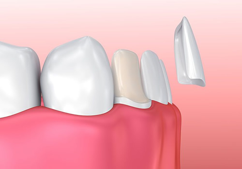 Imagem ilustrando como é feito o tratamento com a faceta dentaria e lente de contato dental